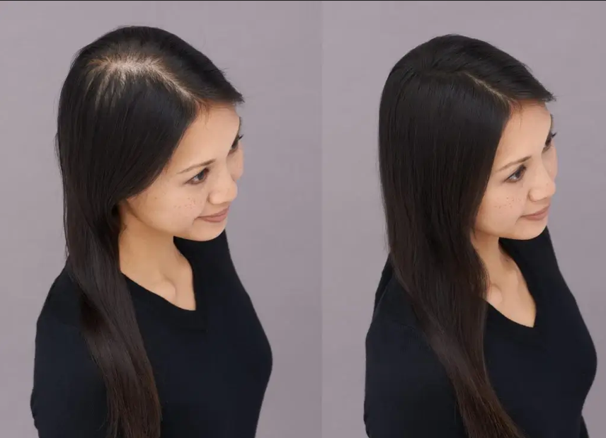 Minoxidil for Women