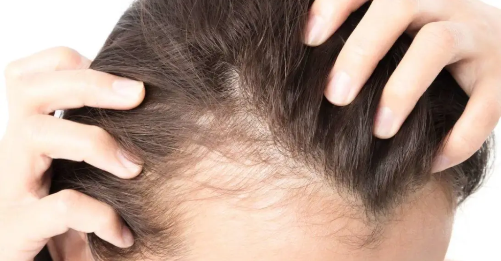 Oral vs Topical Minoxidil