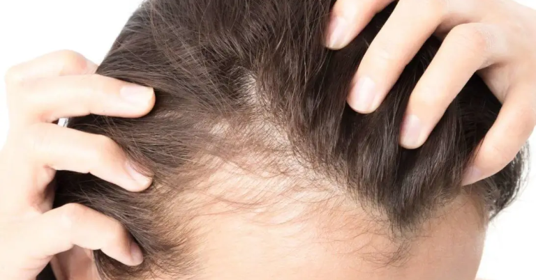 Oral vs Topical Minoxidil