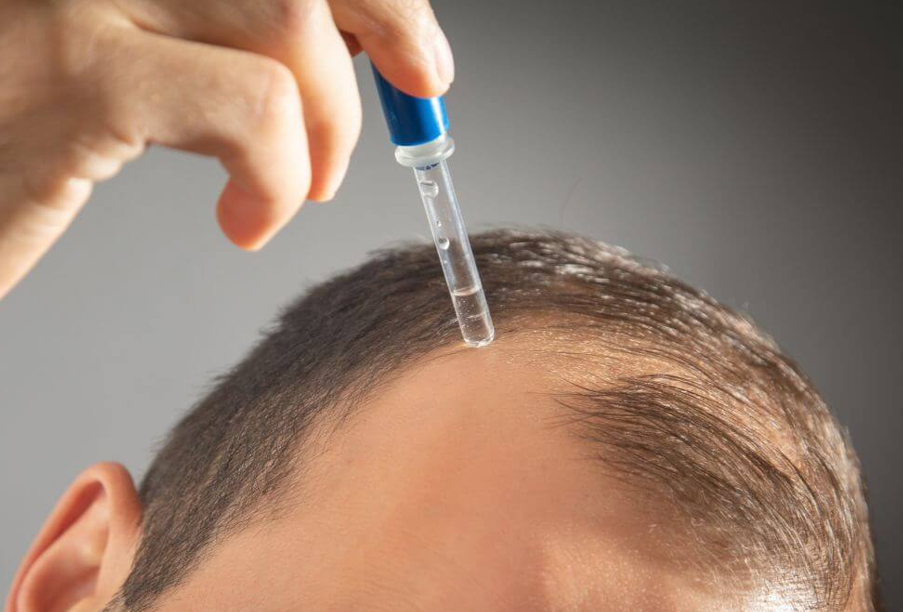 Redensyl vs Minoxidil